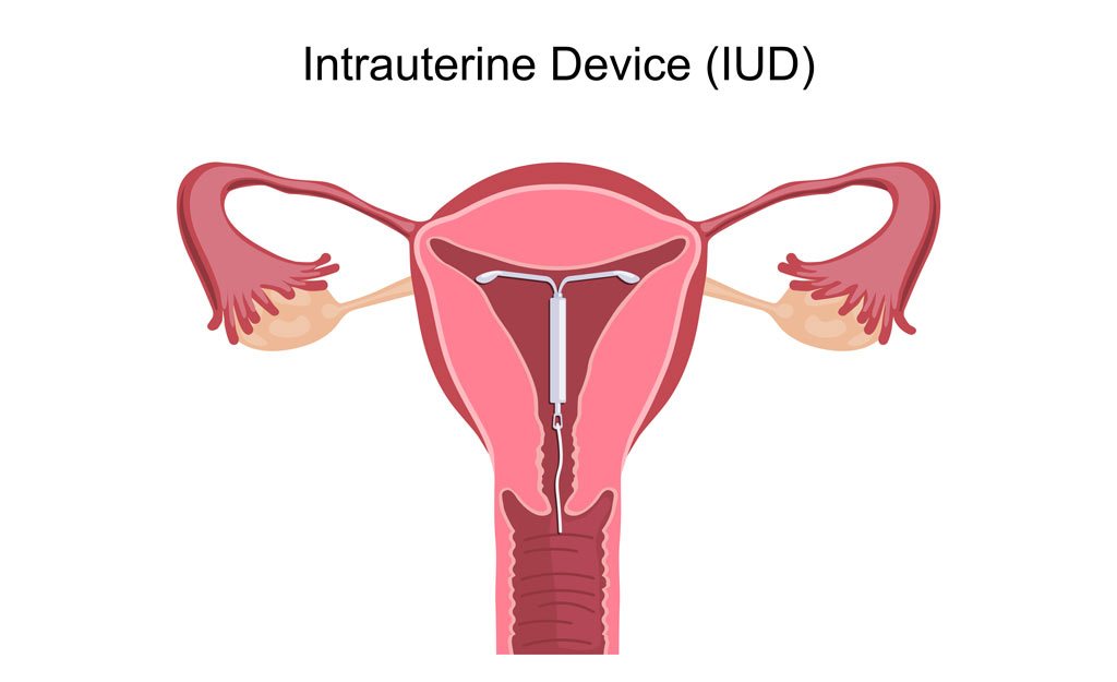Potential dangers of an IUD?